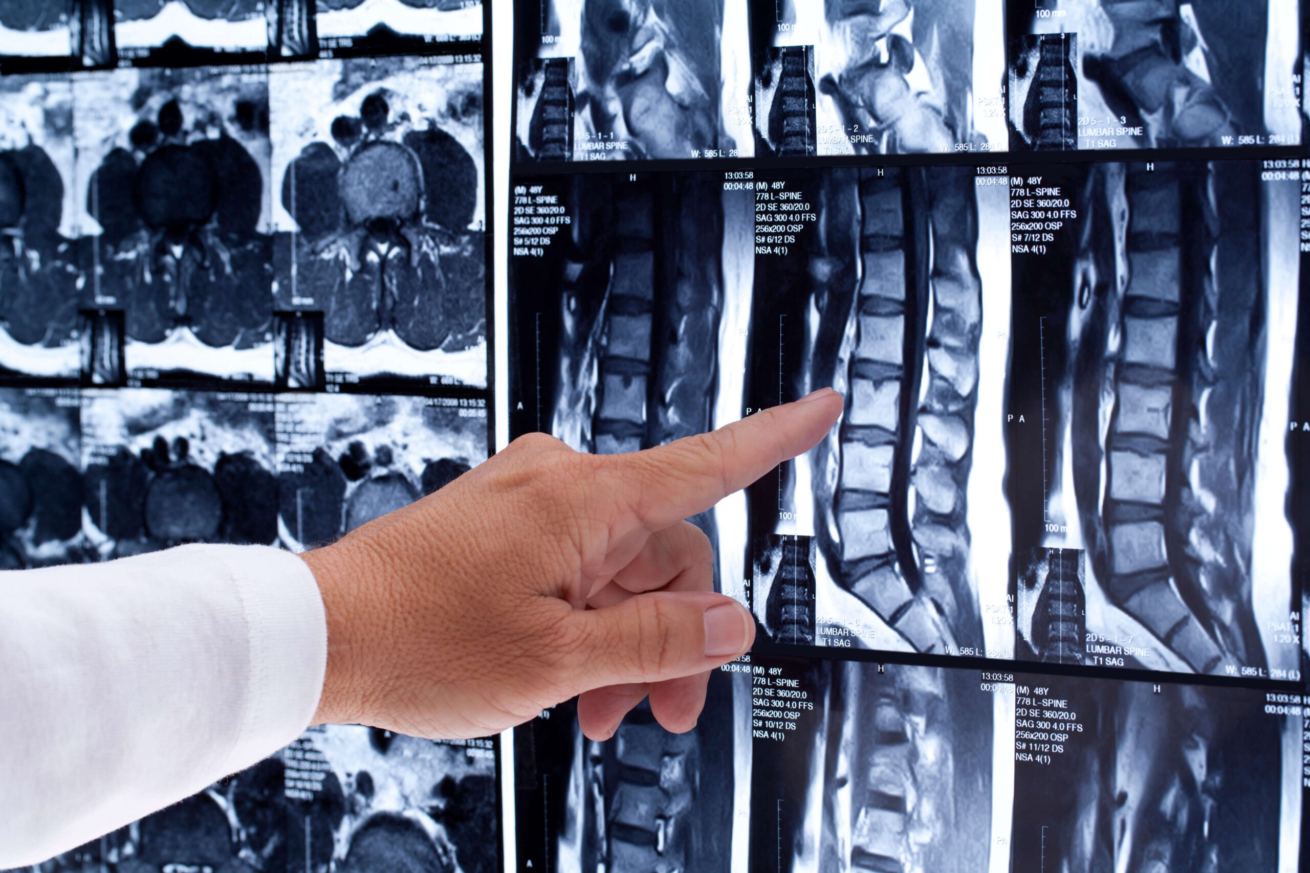 How Are Serious Injuries Like Spinal Cord or Brain Trauma Handled in NC Injury Cases